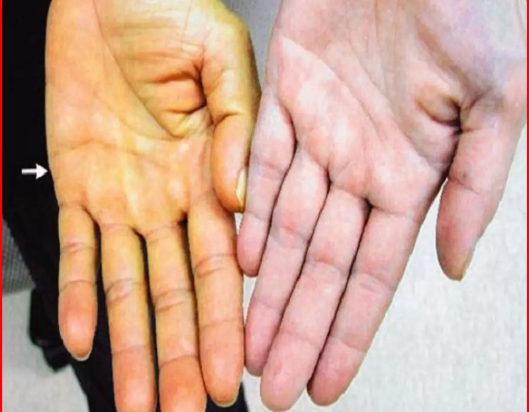3 ABNORMALITIES in the hand warn of liver can.cer