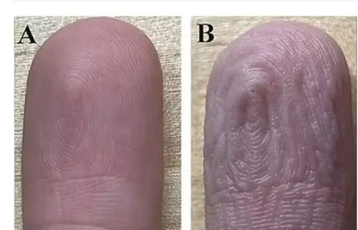Why do fingers wrinkle when soaked in water?