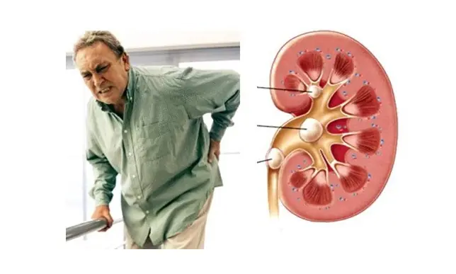Doctors point out 'taboo' foods that damage the kidneys the more you eat them