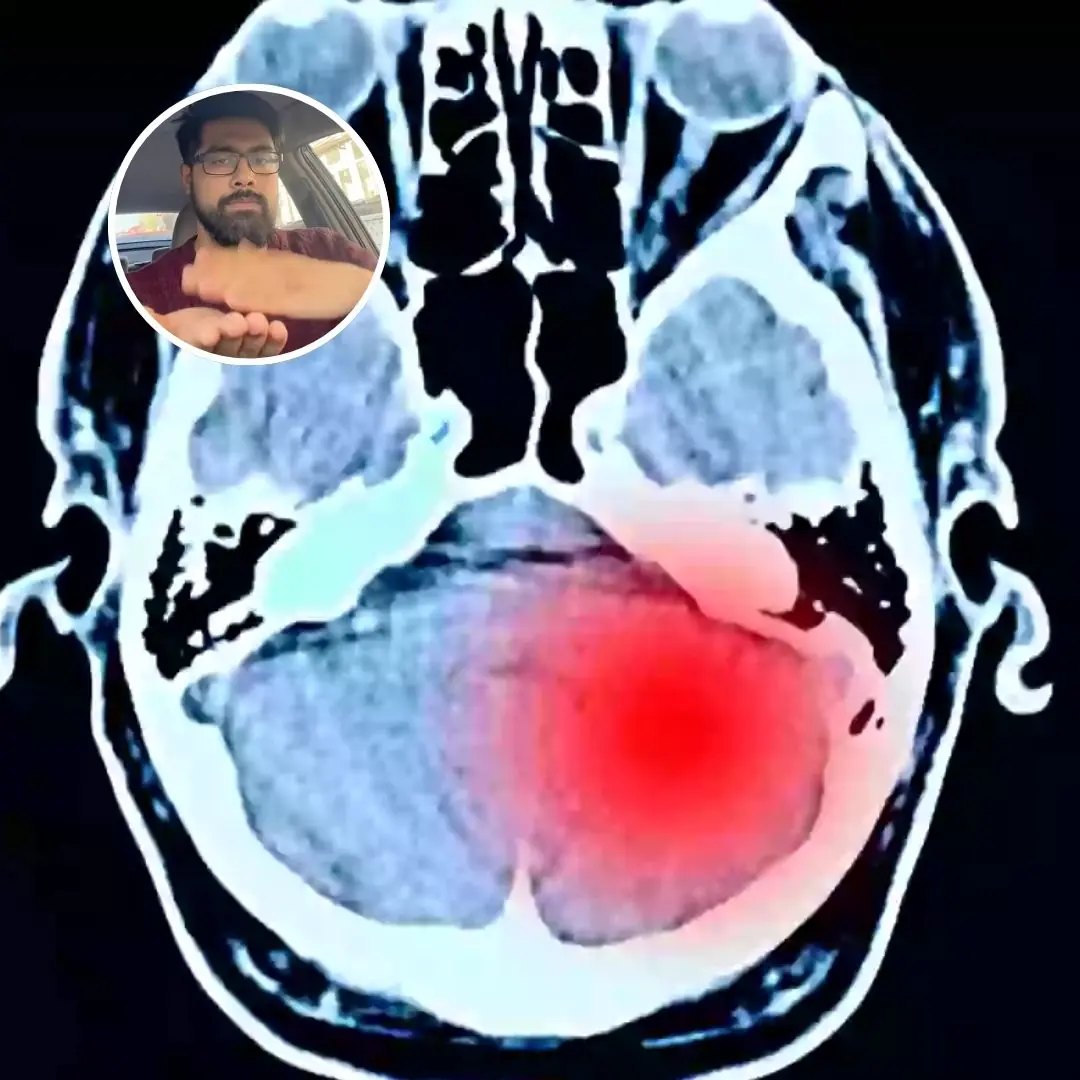 Medic demonstrates the 30-second hand test that could reveal if you have a hidden brain tumour
