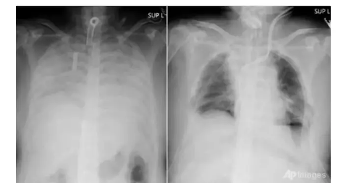 X-rays show many young people have white lungs, what is the cause?