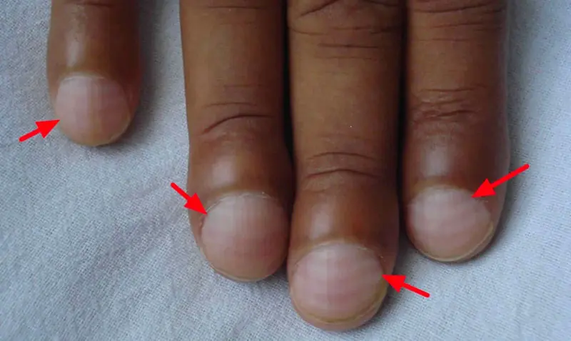 Shoc.king: 5 Alarming Signs in Your Hands That May Indicate Lu.ng Problems