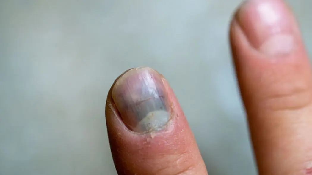 Startled: 5 signs on the hand warn that the lungs are in danger