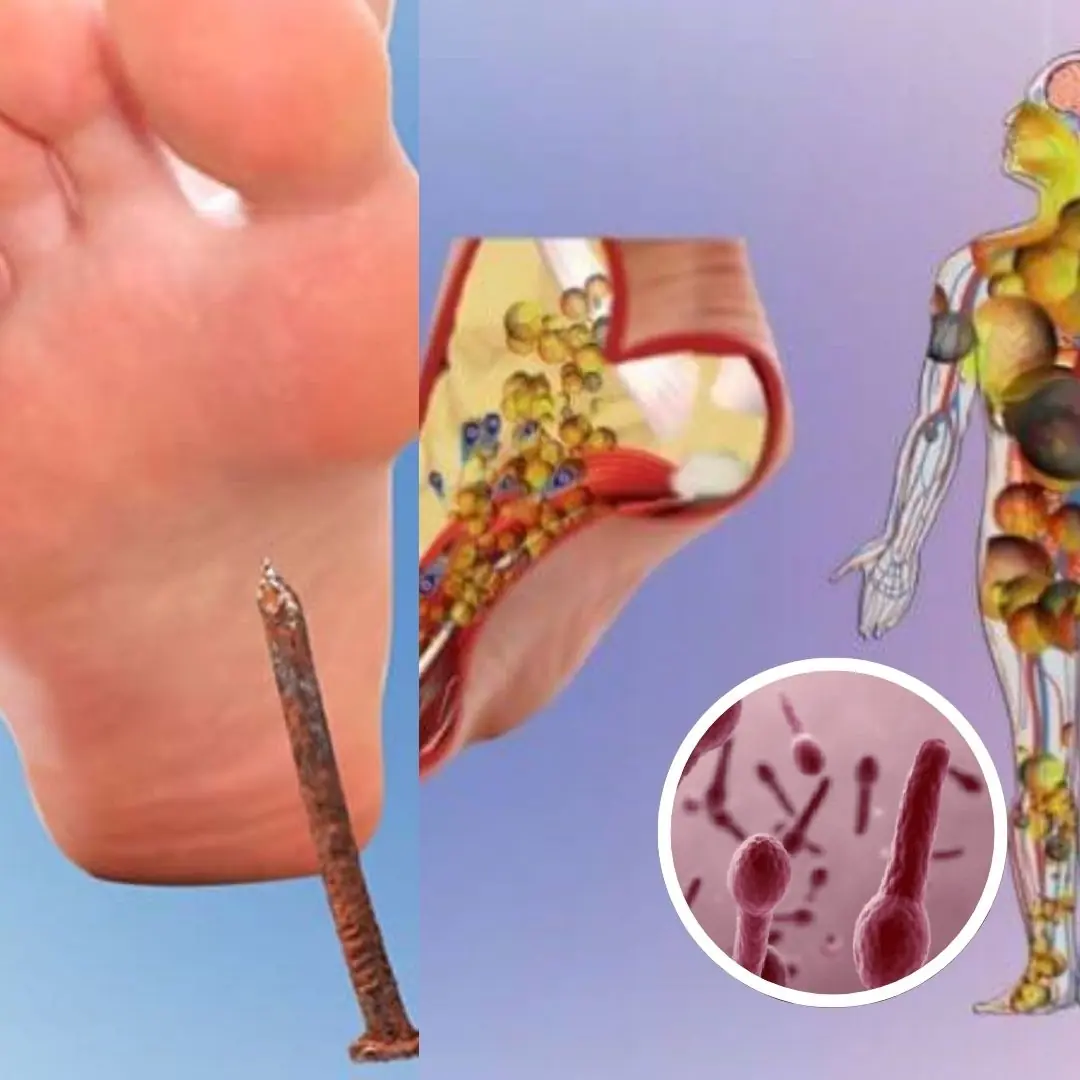 Tetanus Infection – Early Warning Signs