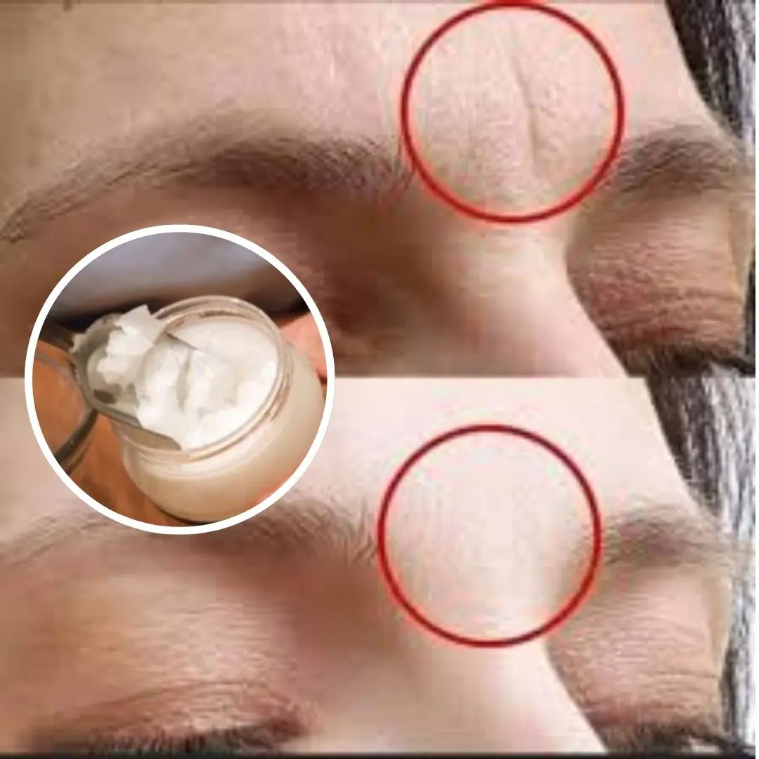 Masks to Eliminate Wrinkles Between the Eyebrows