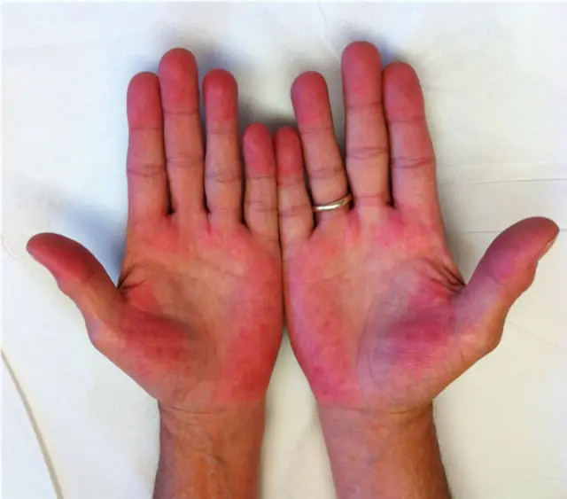 Check Your Skin for Liver Problems: If You See These 3 Colors—Red, Black, or Yellow—See a Doctor Before It’s Too Late!
