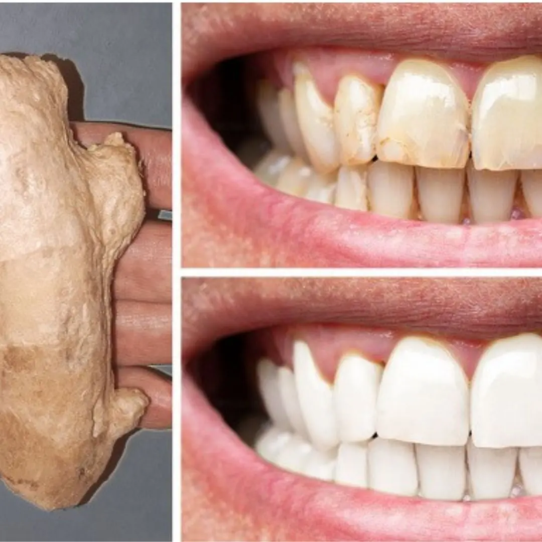 7 Natural Tips to Improve Teeth Whiteness at Home