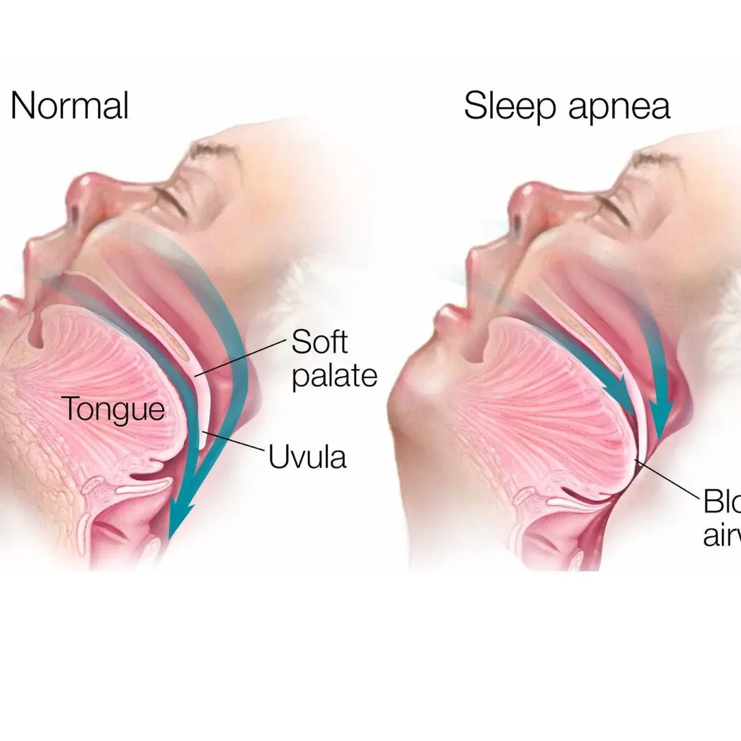 4 Signs You Might Have Sleep Apnea