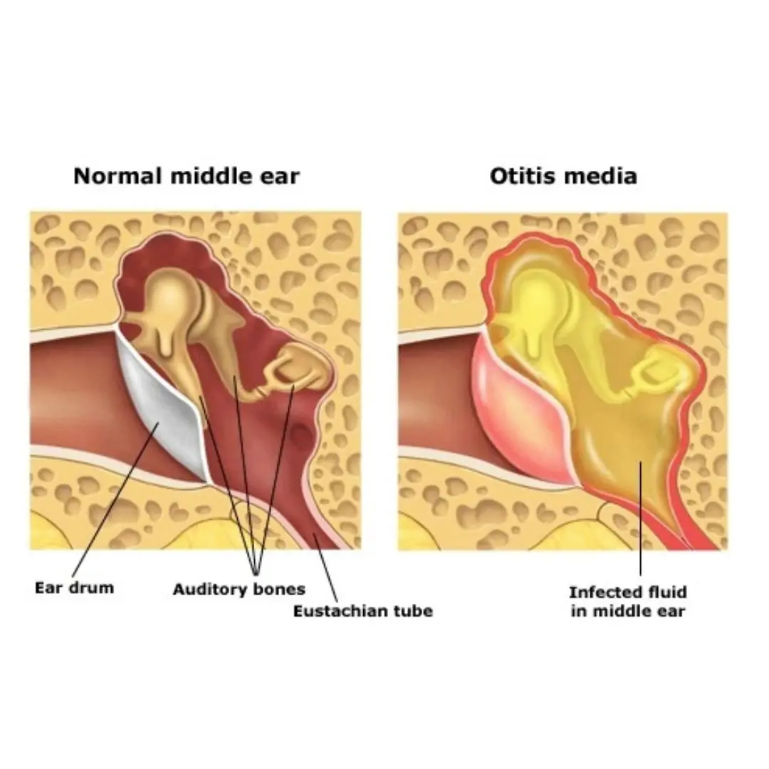 Otitis media – the “hidden culprit” causing vestibular disorders that many people ignore
