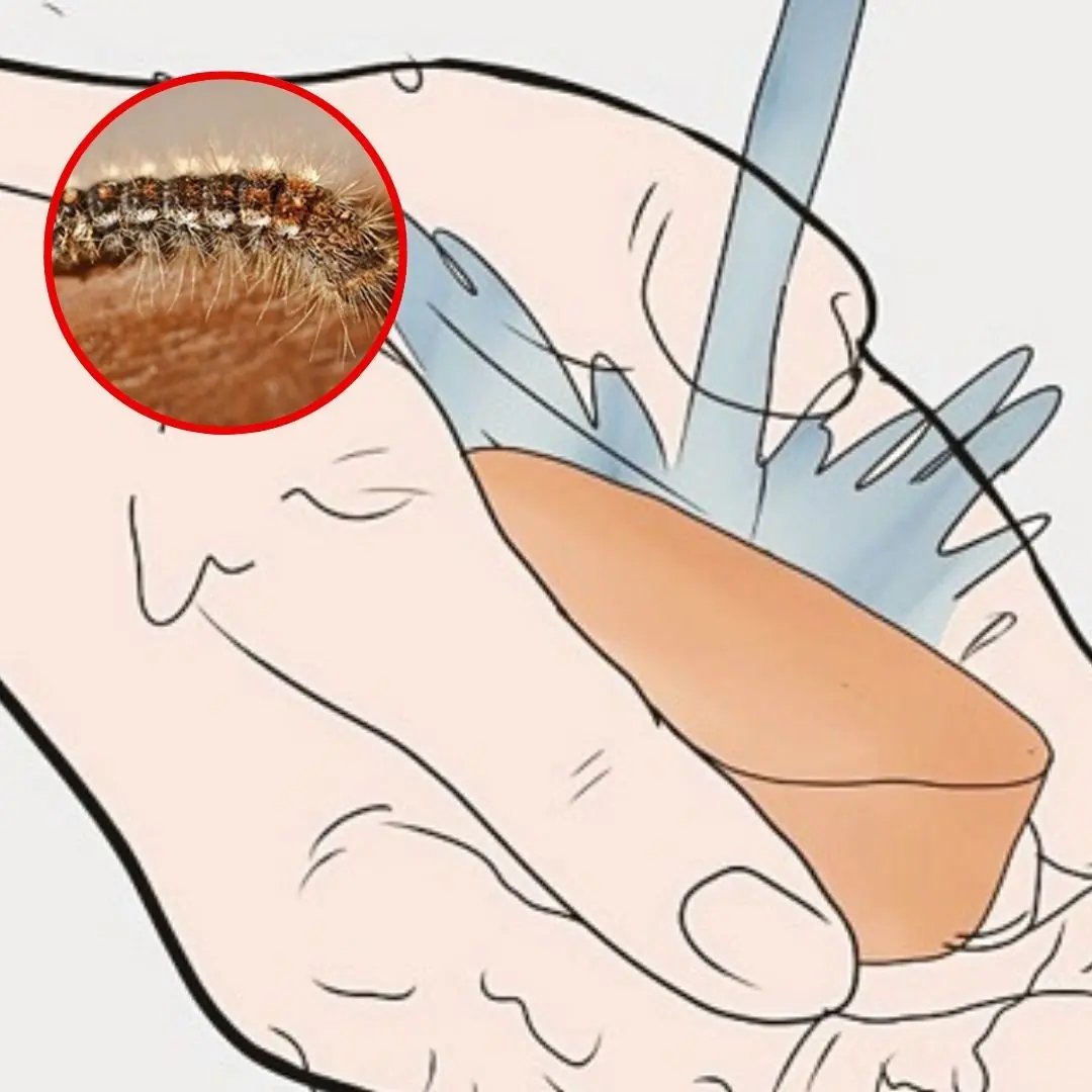 Caterpillar on you: 5 simple steps to treat at home