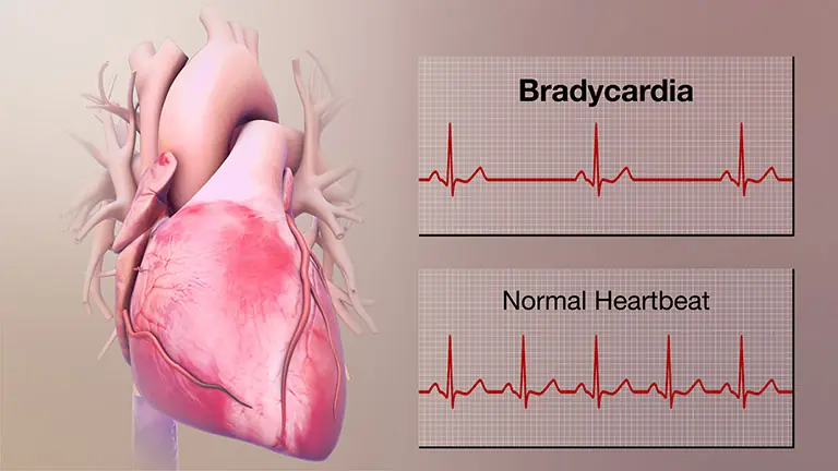 What is the disease of irregular fast and slow heartbeat?
