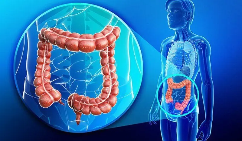 5 habits to prevent colorectal can:cer