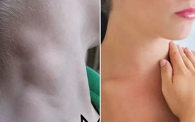 Is swollen lymph nodes in the neck caused by cancer?