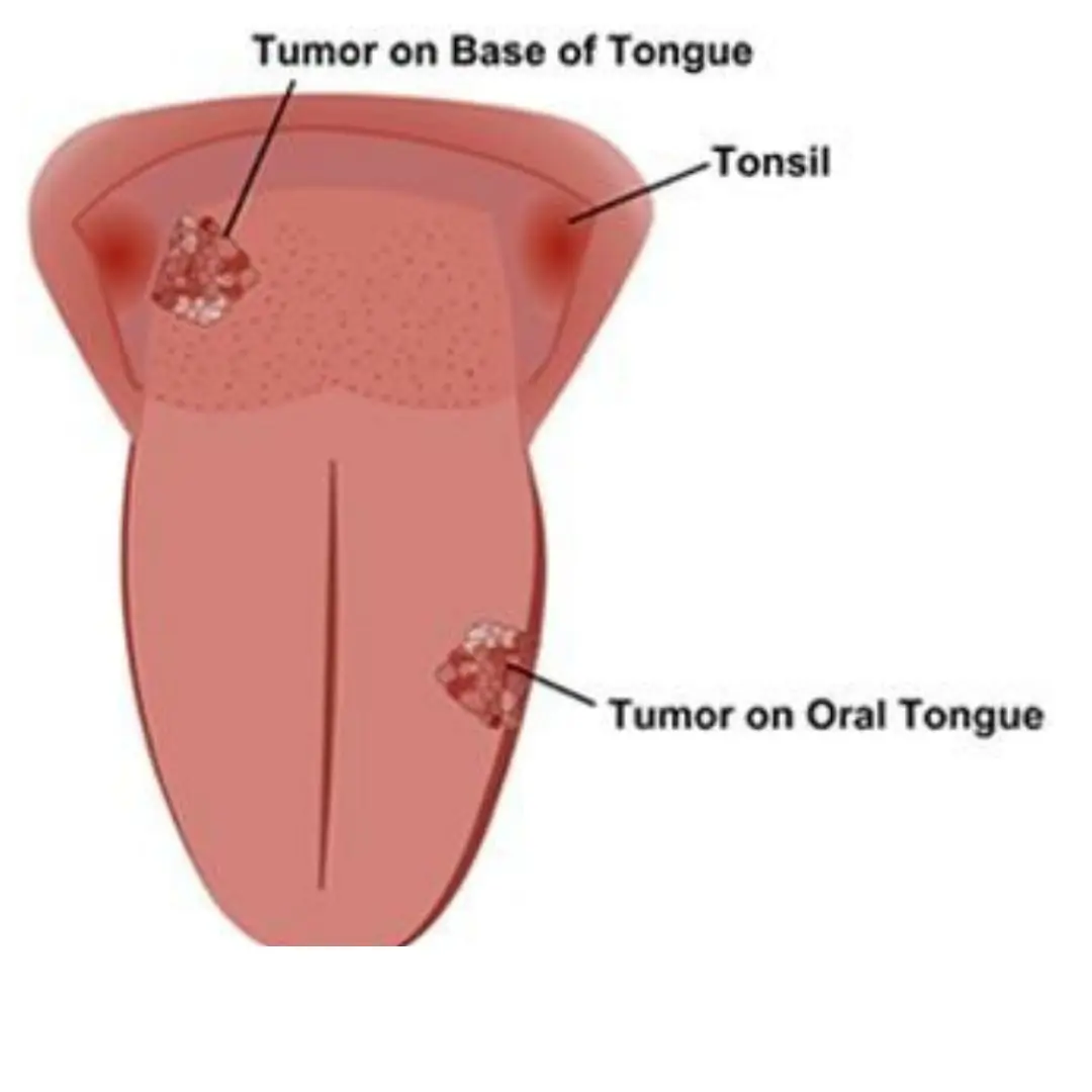 6 warning signs of late stage tongue c.a.ncer