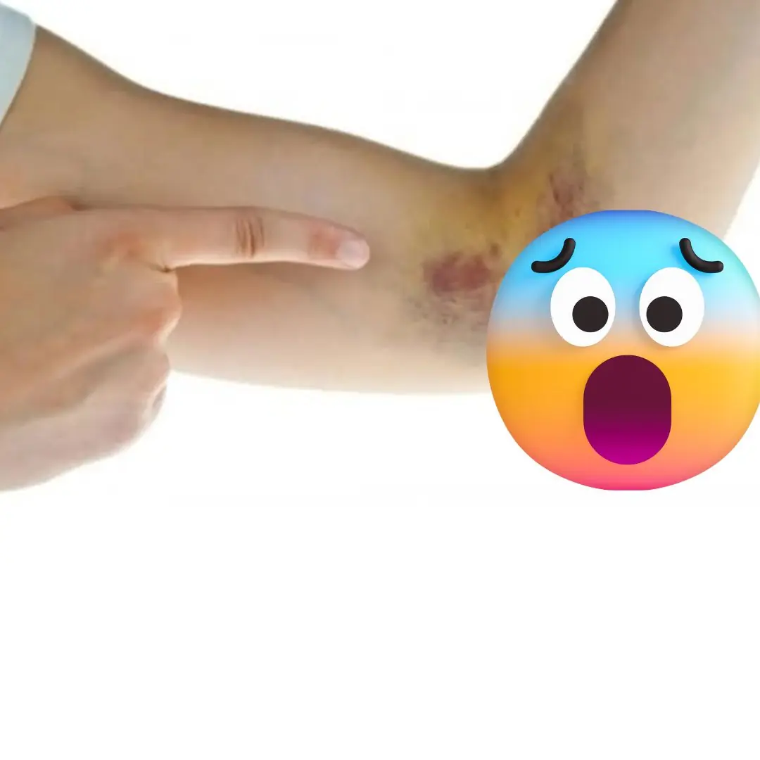 Simple signs to immediately recognize leukemia that you may never notice