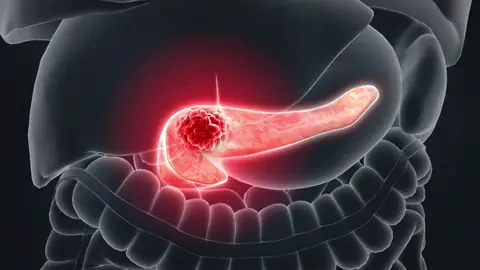 Tumor Disappears After 4 Months of Persistence: Even Doctors Were Amazed