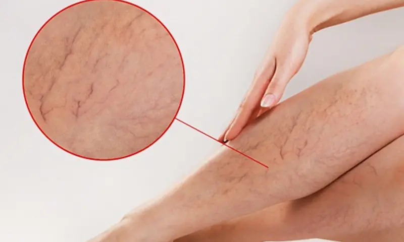 Who is susceptible to varicose veins?