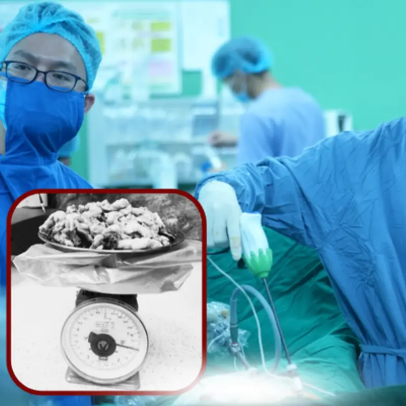 Woman Lived with Uterine Fibroids Weighing Nearly 1.5kg for Over a Decade Without Knowing It — Here's Why