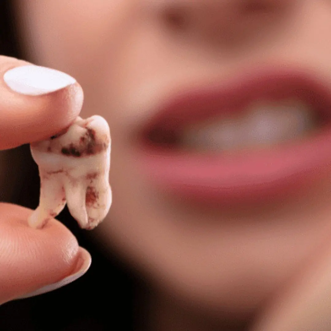 Are Sweets Really the Culprit for Tooth Decay?