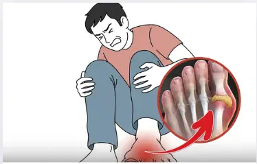 How to lower uric acid: Top diet choices and foods to prevent gout