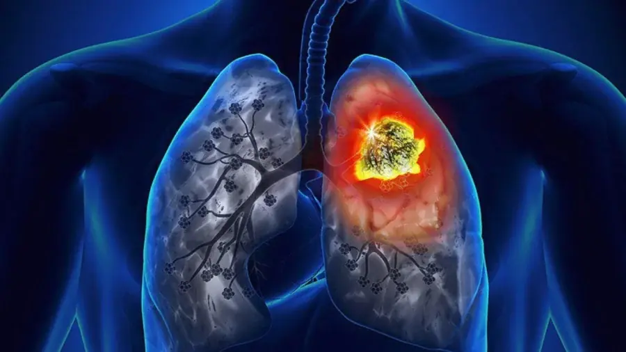 7 Early Warning Signs of Lu.ng Can.cer: Get Checked Before It Spreads