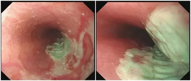 Esophagus "cut off" because of bad habits! Many people like to do this