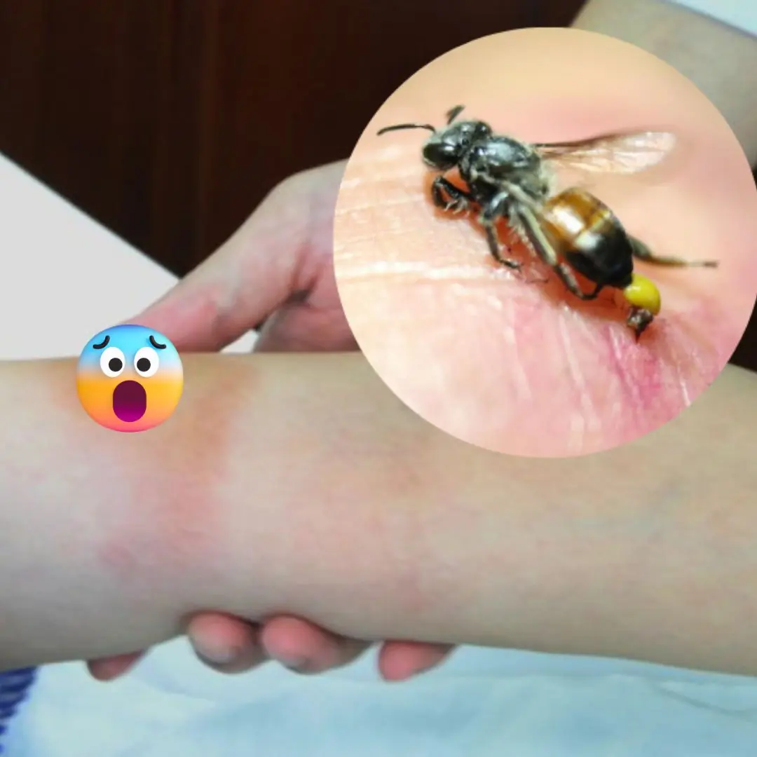 How to relieve bee sting pain at home