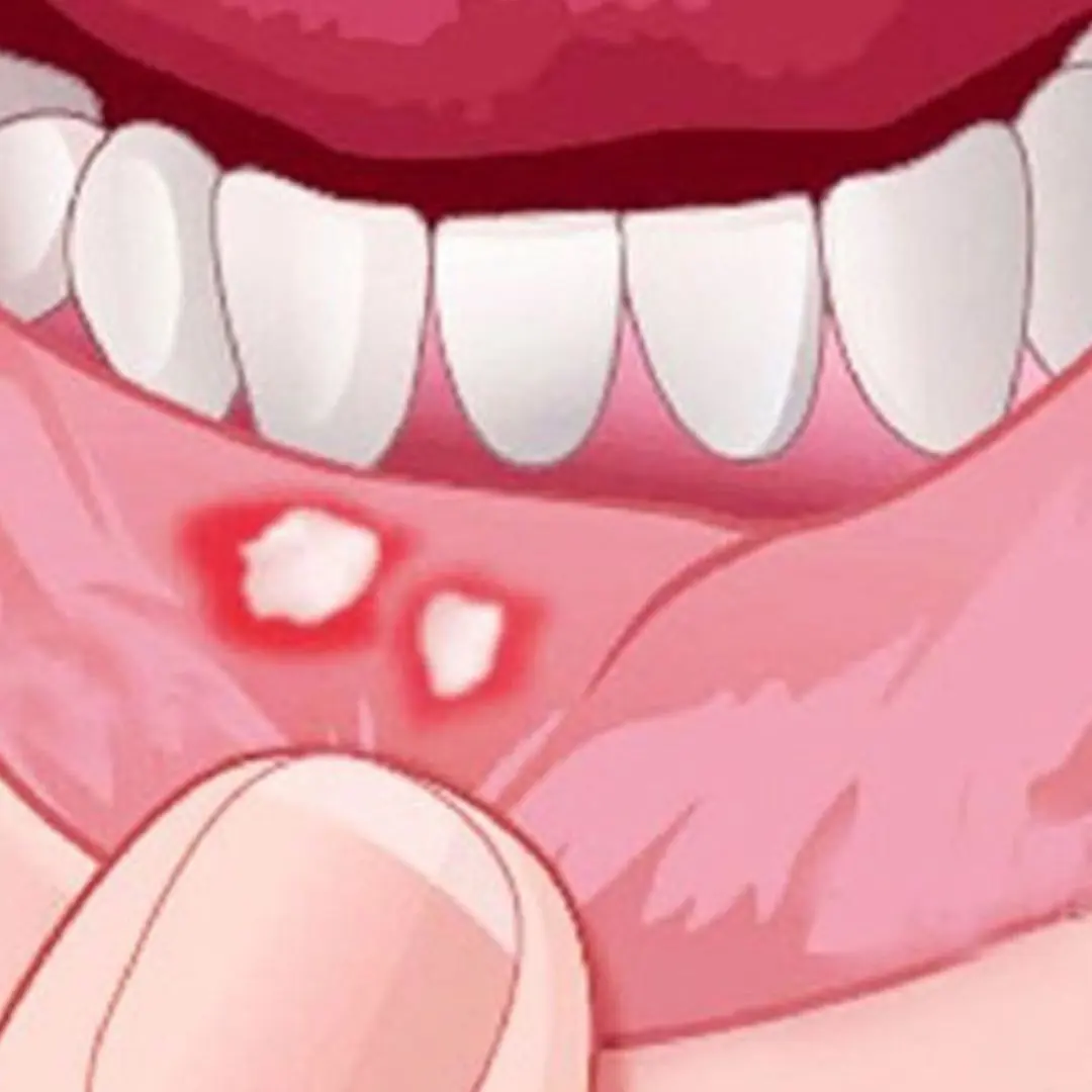 Mouth ulcers keep coming back? Don't ignore the following causes