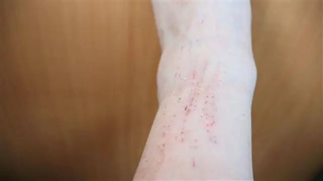 Woman Develops Skin Ulcers After 20 Years of Eating Only Boiled Food