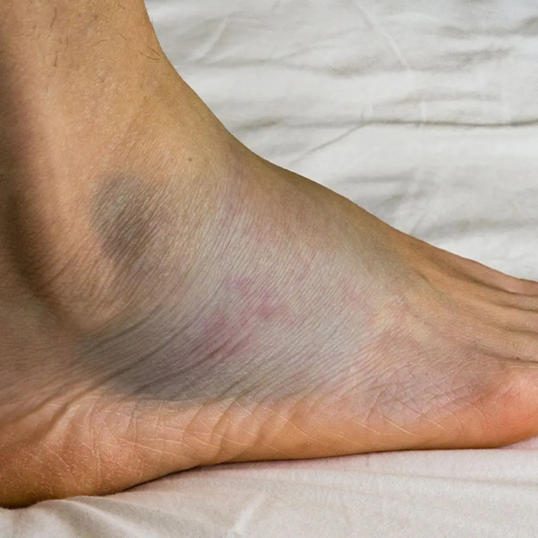 Swollen legs and edema are symptoms of what disease?