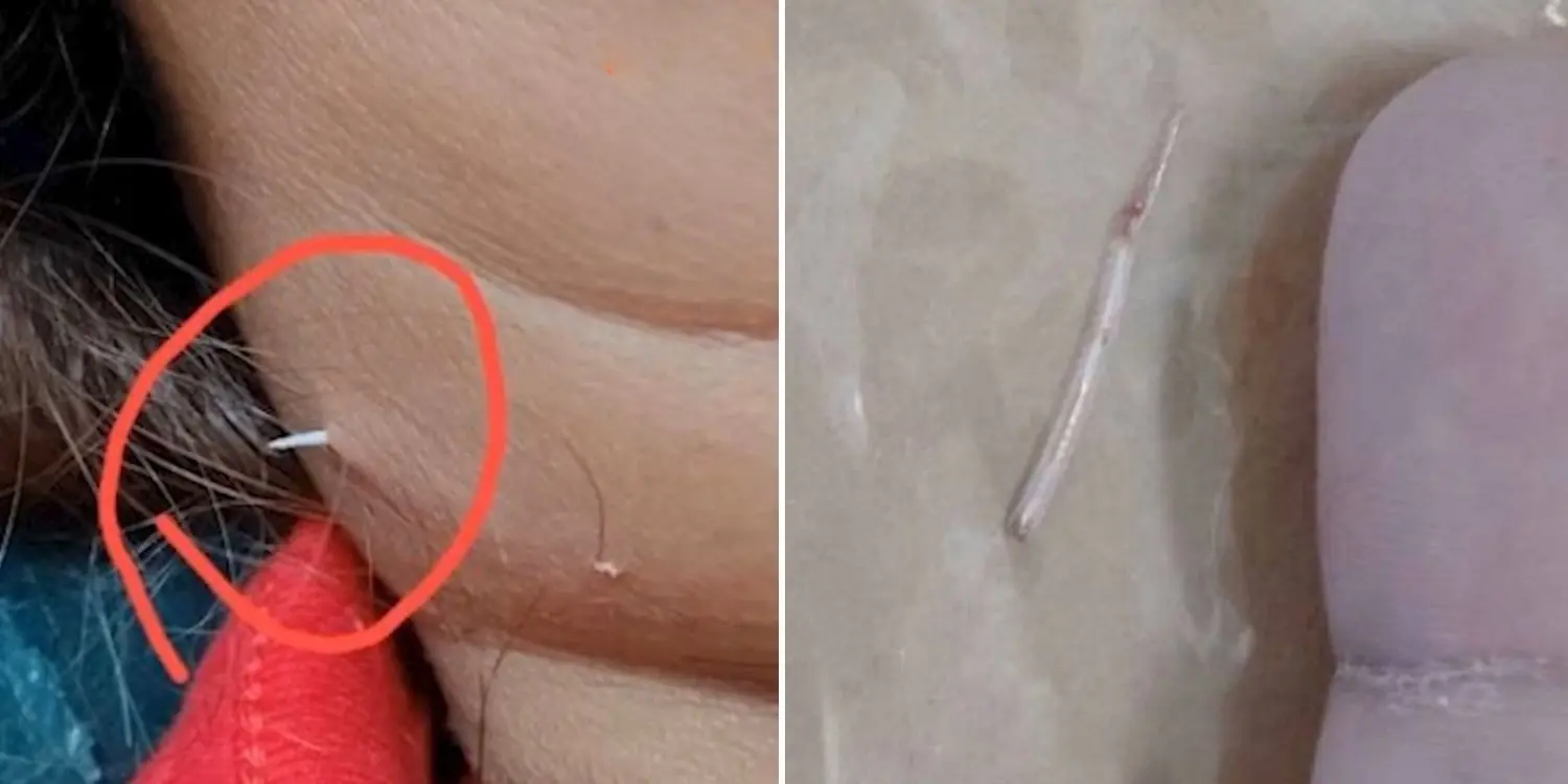 Neck pain, woman shocked to see something sticking out