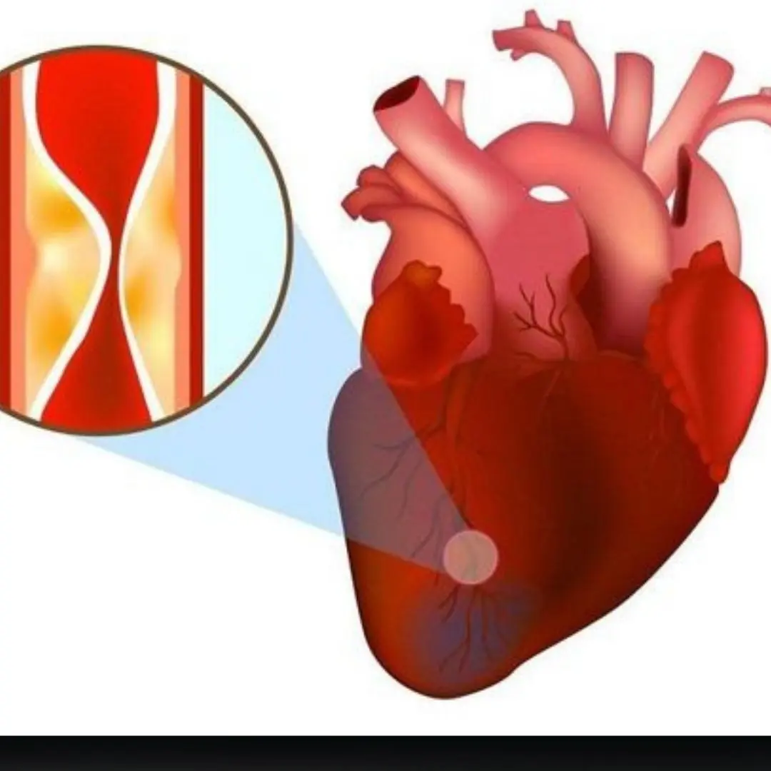 Who is at high risk for myocardial infarction?