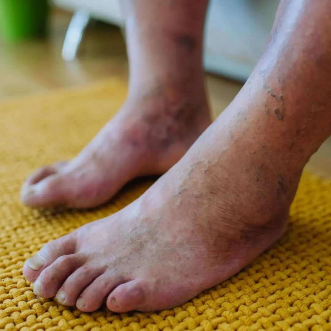 What’s Behind the Purple Color in Your Feet? Causes You Shouldn’t Ignore
