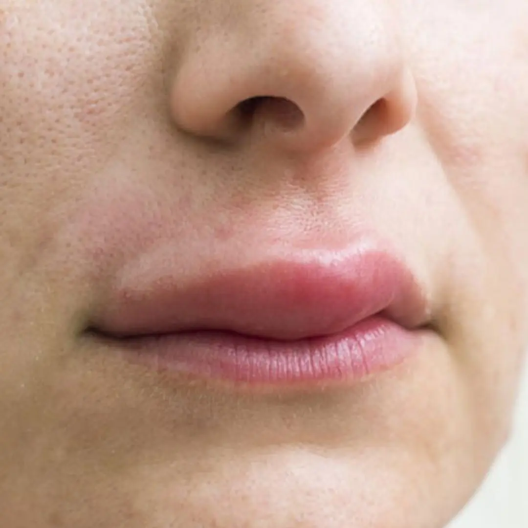 What is the disease of waking up with a swollen upper lip? Causes and treatment