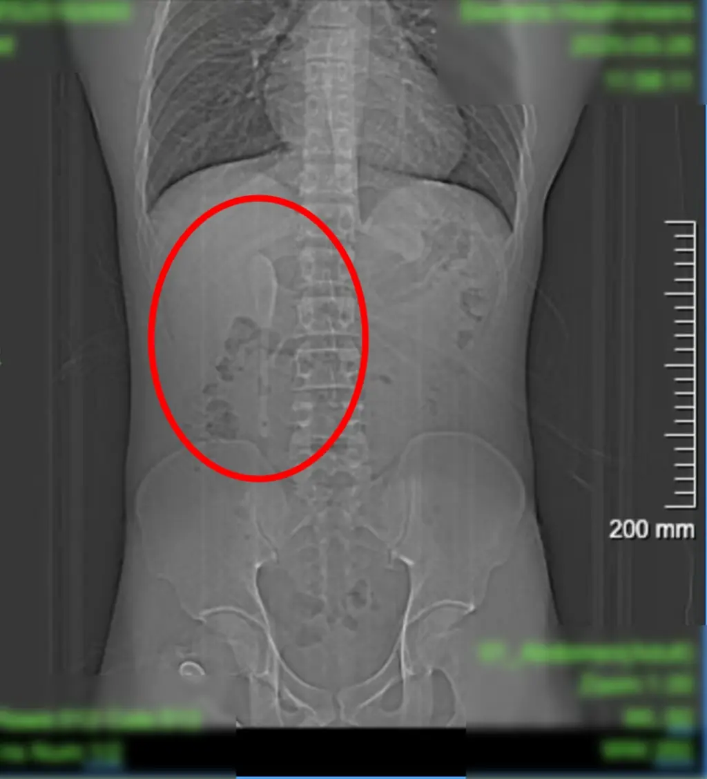 Man Goes to Hospital for Sto.mach Pain—Doctors Shocked by What They Find Inside