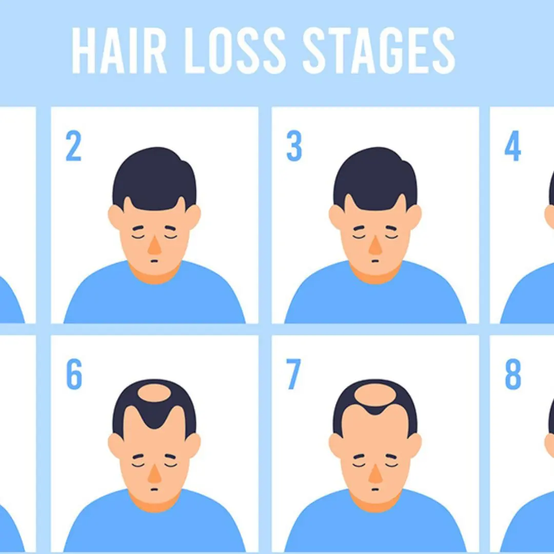 When Does Male Pattern Baldness Start And How To Prevent It