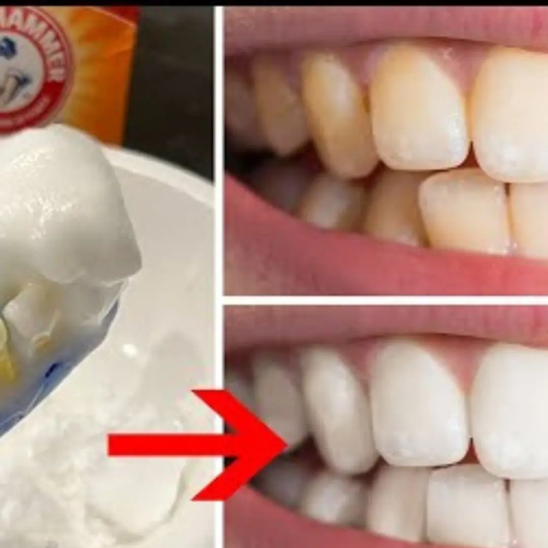 9 Natural Remedies For Teeth Whitening