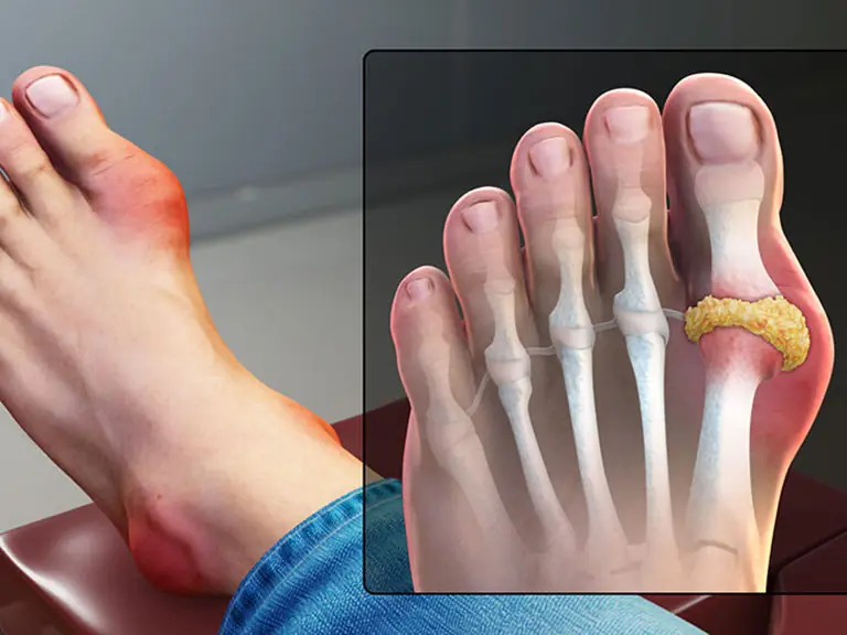 Those with gout should absolutely avoid these foods