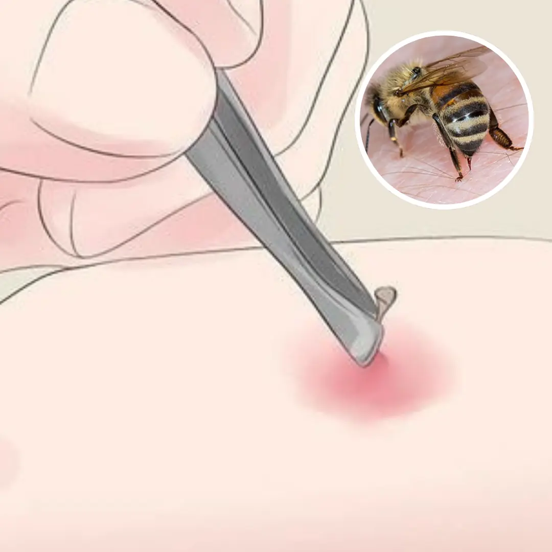 Is bee sting da.ng.erous and what is first aid?