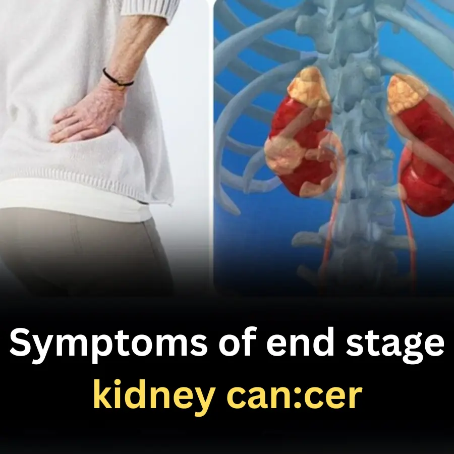 Symptoms of end stage kidney can,cer