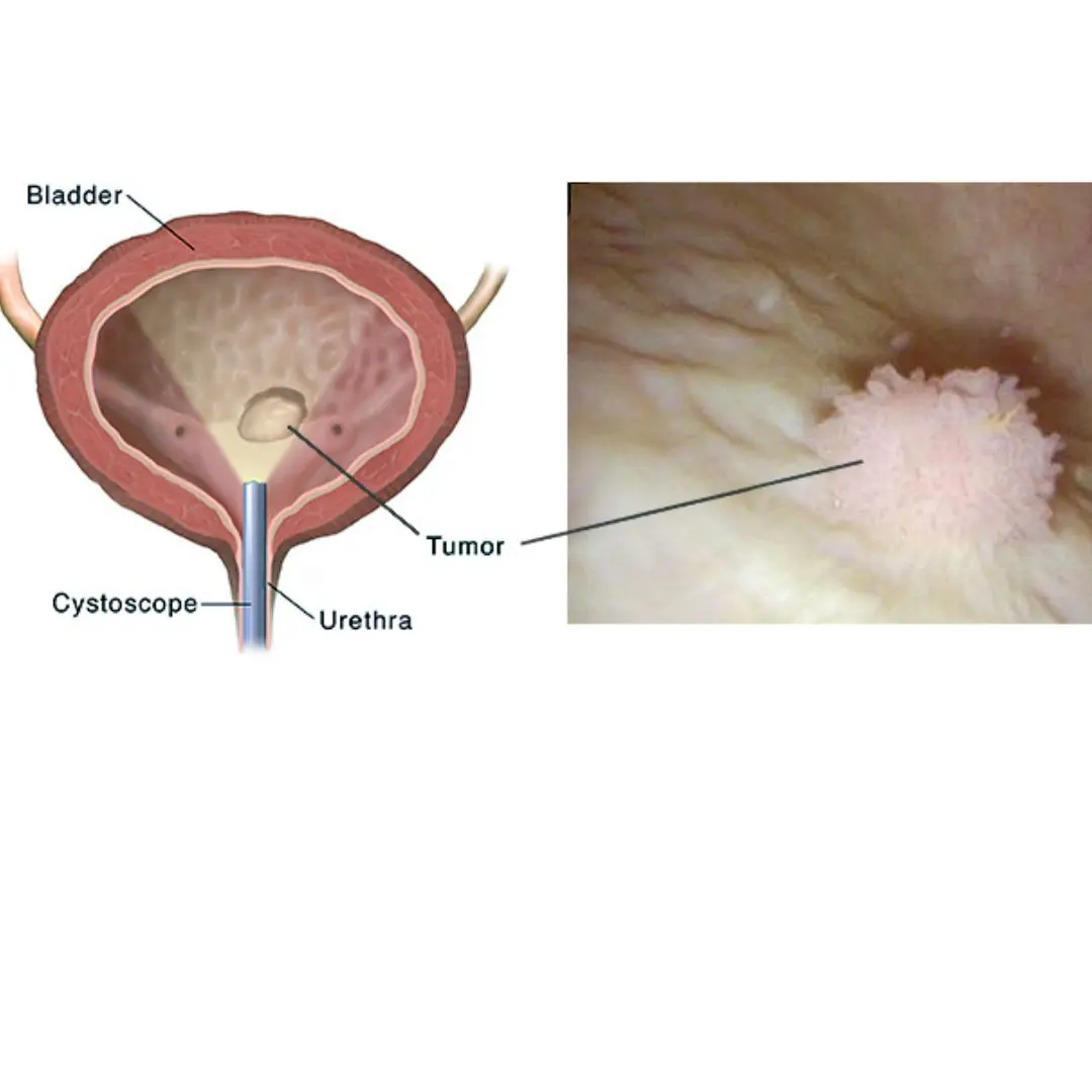 Bladder Ca.ncer: Symptoms You Shouldn’t Ignore