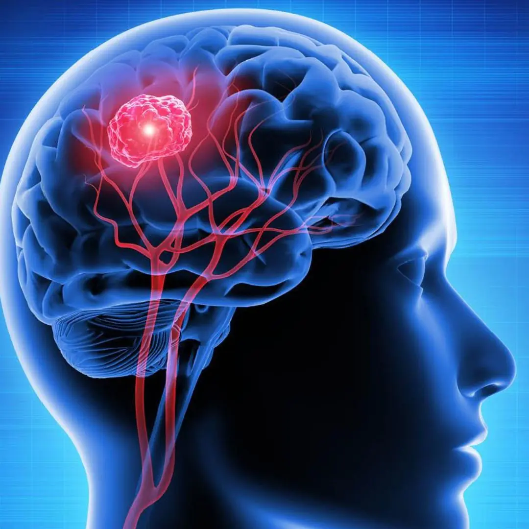 7 signs of brain c.a.ncer that are easily confused with other diseases