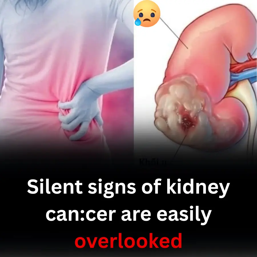 Silent signs of kidney can.cer are easily overlooked