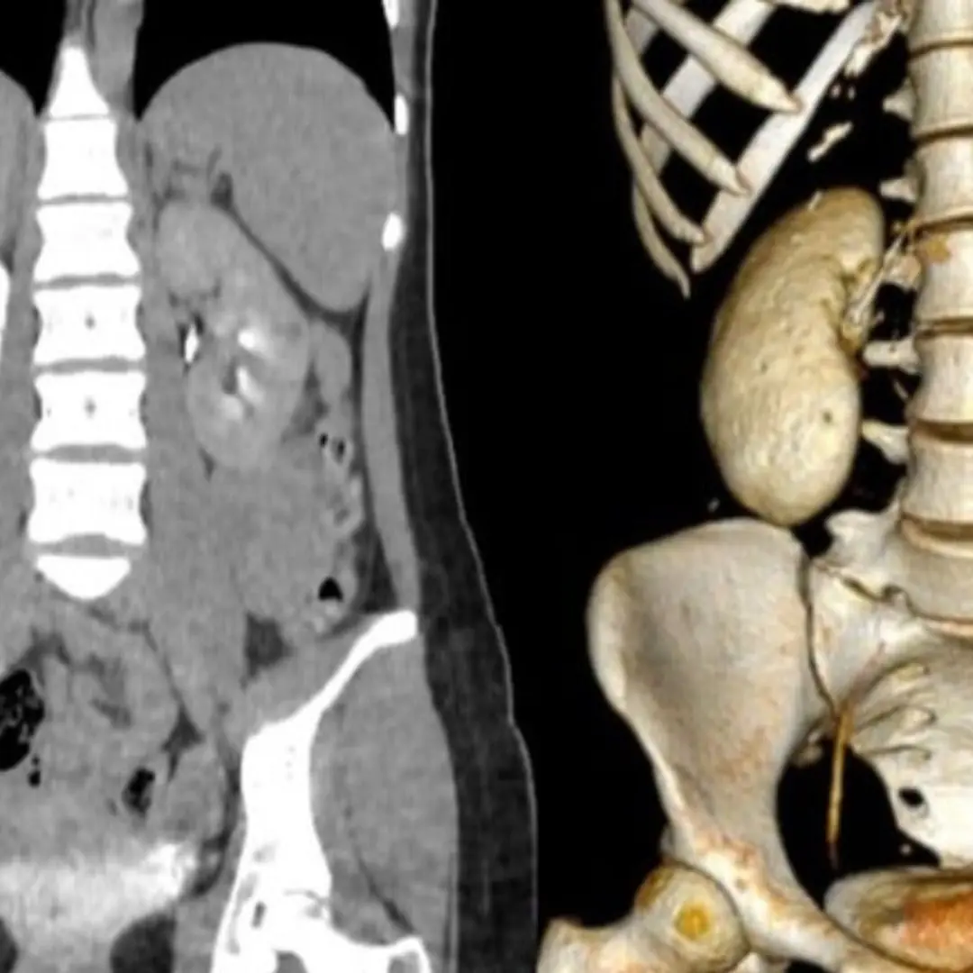 Eating habits d.e.stroy 18 year old girl's kidneys