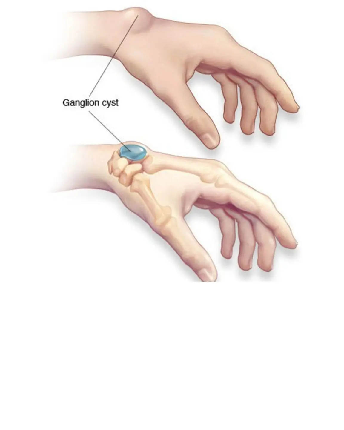 When you have a painless lump, don't 'guess' whether it's good or bad, a late examination can lead to a disability