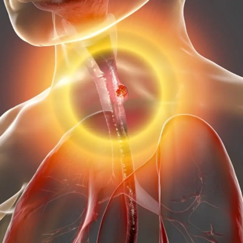 A Common Eating Habit That May Raise Your Risk of Esoph.ageal Can.cer