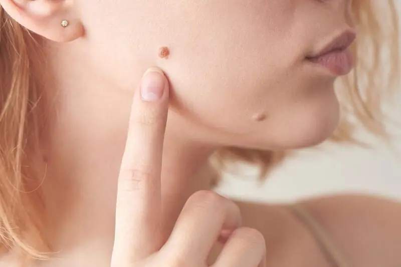 3 Mole Locations That May Signal Skin Can.cer: Don’t Ignore These War.nings