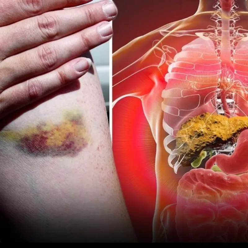 Warning Signs of an Unhealthy Liver: Watch for '3 Yellows and 1 Red'