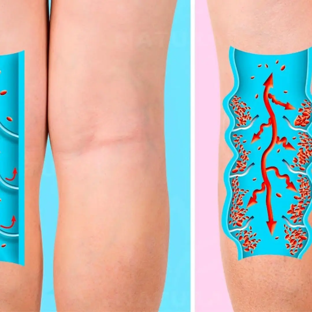 Tired of Poor Circulation and Varicose Veins? Try These 6 Effective Tips!