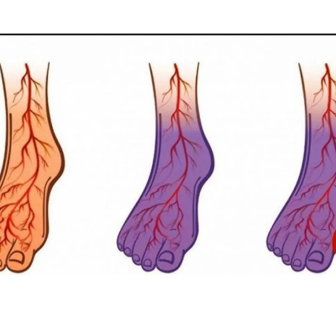 5 Things That Put You at Greater Risk for Developing Varicose Veins